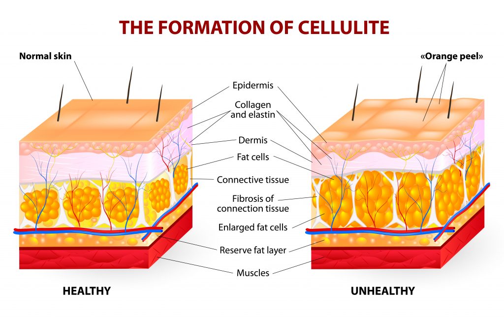 The Formation Of Cellulite