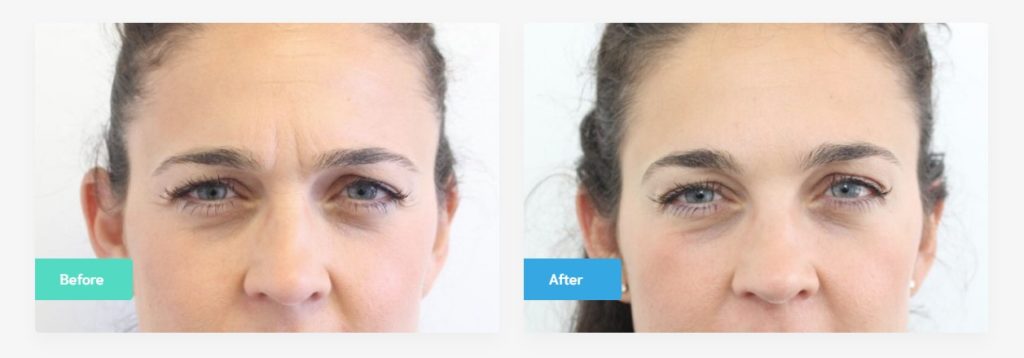 botox treatment before and after